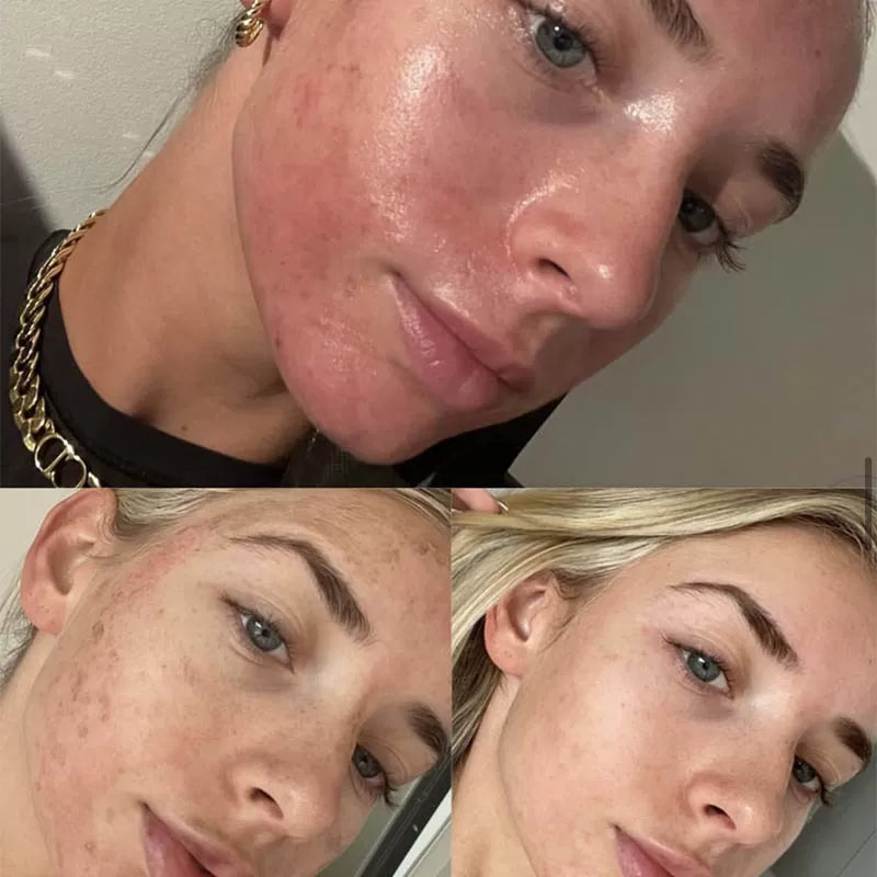 Clear Acne & Redness at Home