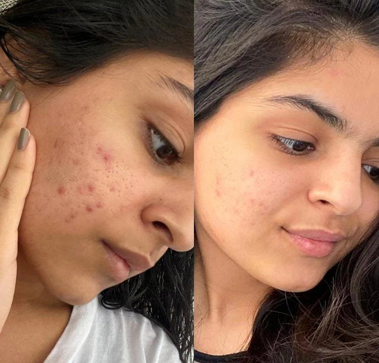 Clear Acne & Redness at Home