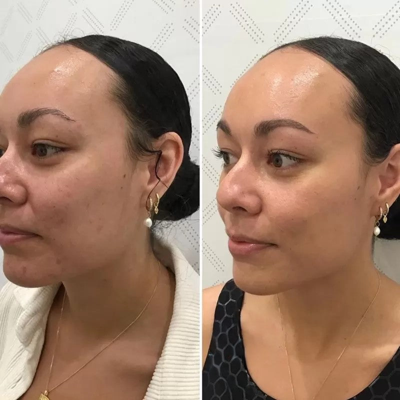 Clear Acne & Redness at Home